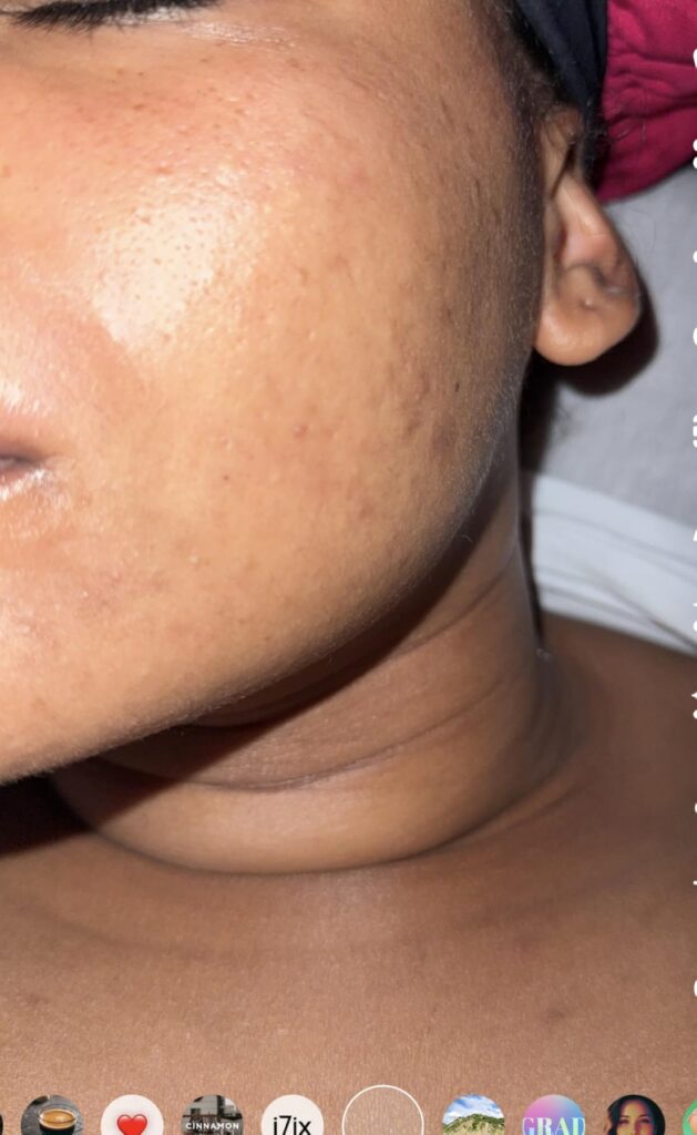 differin gel acne treatment