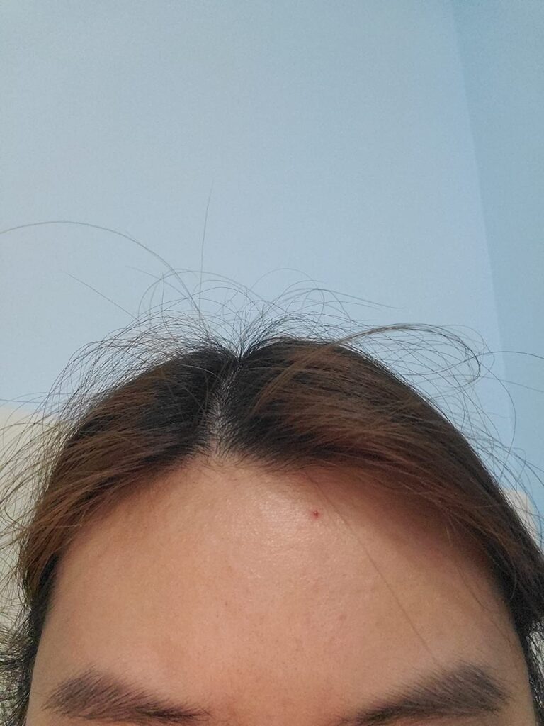 differin gel acne treatment
